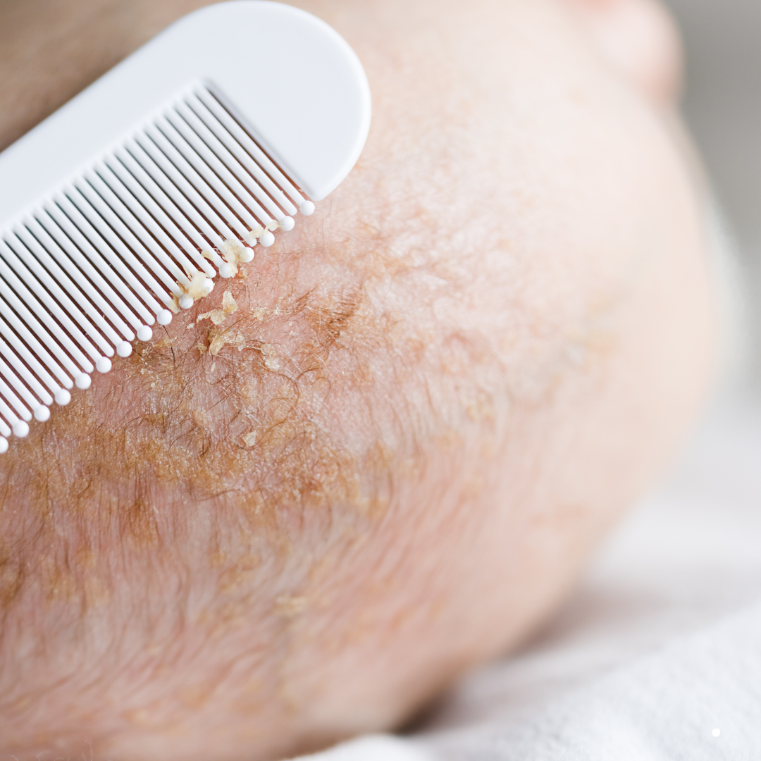 Cradle Cap and Bath Time